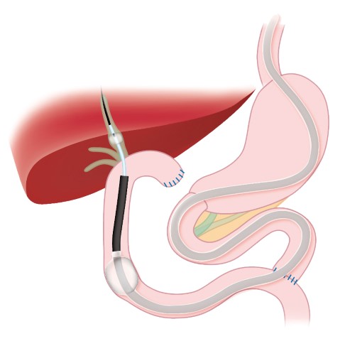 ERCP