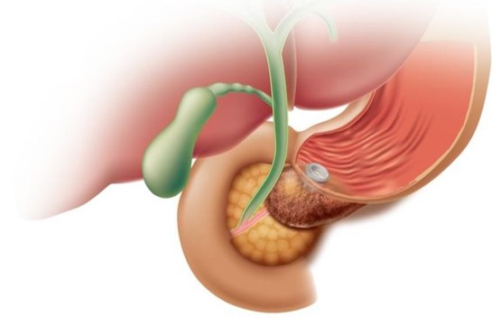 EUS-経胃ドレナージ